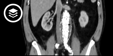 Bauchaortenaneurysma (CT)