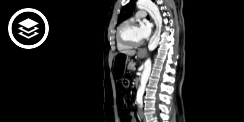Aortendissektion (CT)