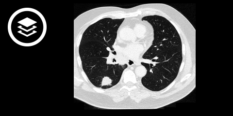 Bronchialkarzinom (CT)