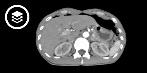 Magenperforation (CT)