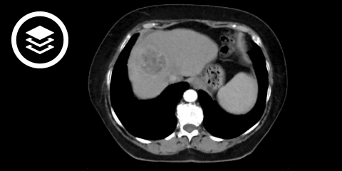 Hepatozelluläres Karzinom (CT)