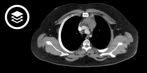 Hodgkin-Lymphom (CT)