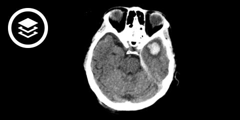 Intrakranielle Blutung (CT)