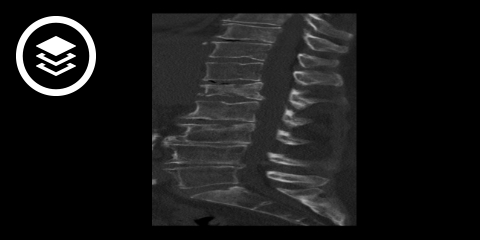 Wirbelkörperfraktur (CT)