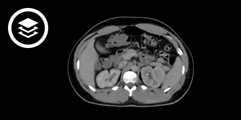 Nephrolithiasis (CT)