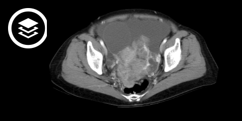 Ovarialkarzinom (CT)