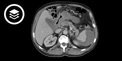 Pankreatitis (CT)