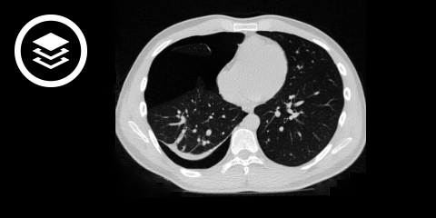 Pneumothorax (CT)