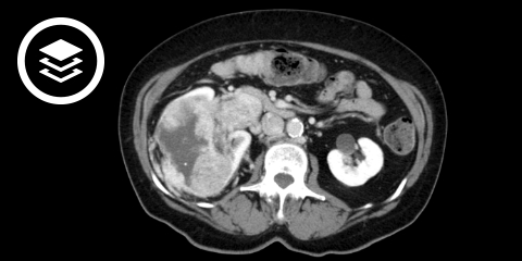 Nierenzellkarzinom (CT)