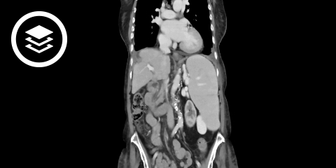 Splenomegalie (CT)