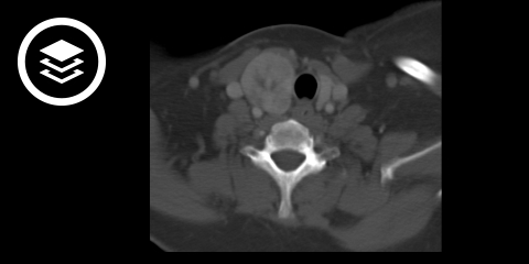 Schilddrüsenkarzinom (CT)