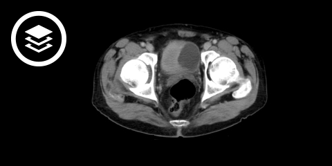 Urothelkarzinom (CT)