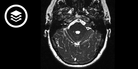 Akustikusneurinom (MRT)