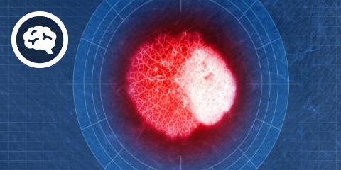 DocCheck eCME: Rotes Licht fürs Melanom (1 CME-Punkt)